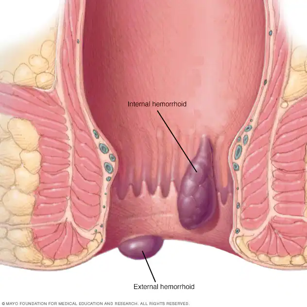 hemorrhoid symptoms