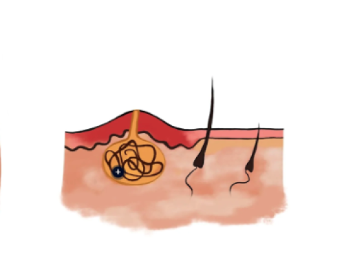 What Are Pilonidal Cysts?