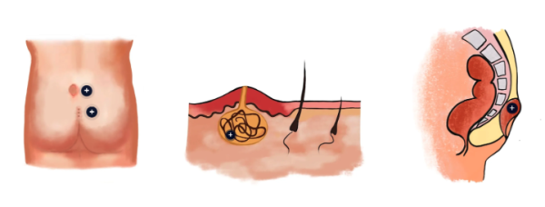 What Are Pilonidal Cysts? - Colon & Rectal Surgery - New York